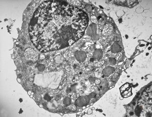 M,62y. | bone marrow - plasmocytoma M,62y. | bone marrow - plasmocytoma